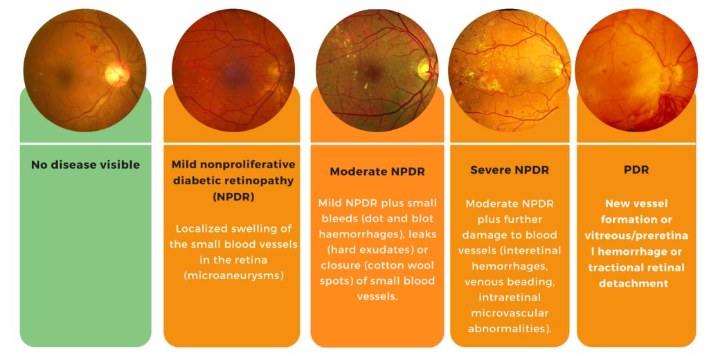 Diabetic Retinopathy Stages Sulodexide A New Model For Treating